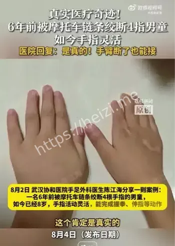 断指再植