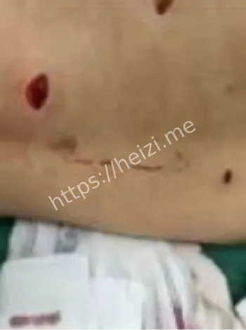 邢台临西龙旺村第七小学女孩被捅6刀