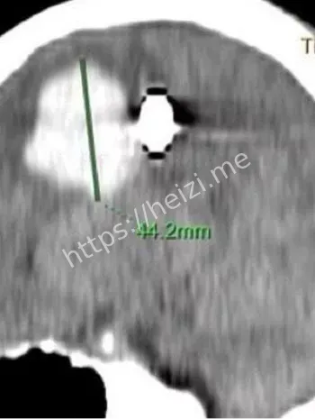 儿童意外脑出血恢复前景